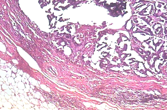 Breast Tumor Classification